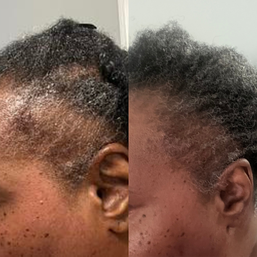 Estervettie's edges and hairline before and after regrowth