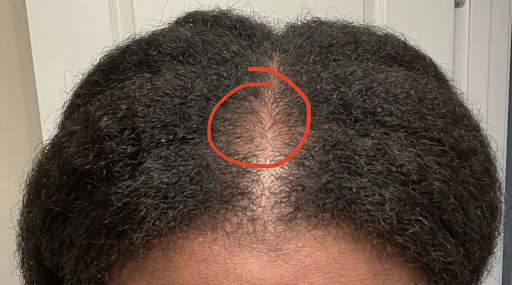Close-up of a crown with a red circle marking the spreading area of thinning hair