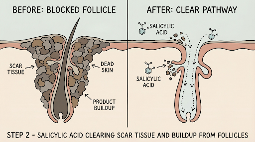 Before and after diagram showing salicylic acid clearing scar tissue and product buildup from a blocked follicle