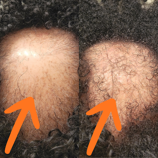 Angela's crown before and after, with orange arrows showing new growth